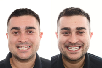 before after images porcelain veneers
