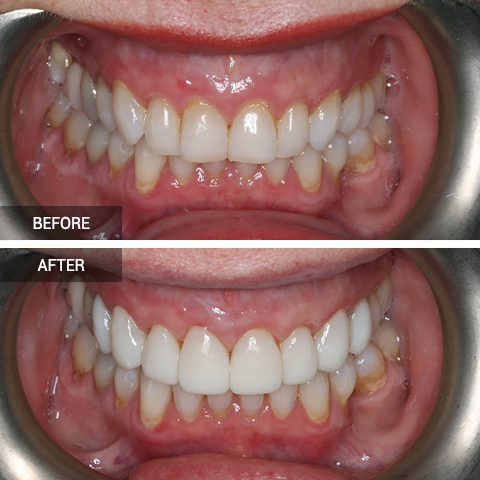 ProblemPatient’s upper front teeth moved since completing Invisalign treatment and they were no longer perfectly aligned. TreatmentEight composite veneers were placed on her upper front teeth.Treatment DurationOne visit