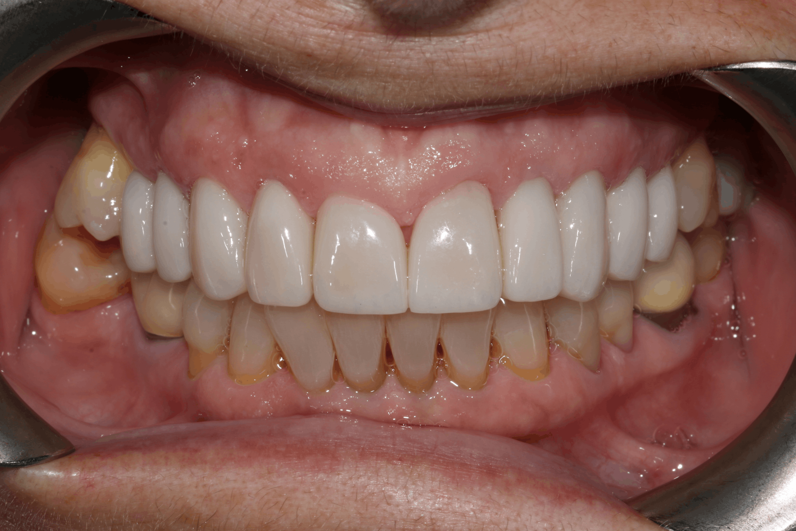 Isabelle before after dental treatment