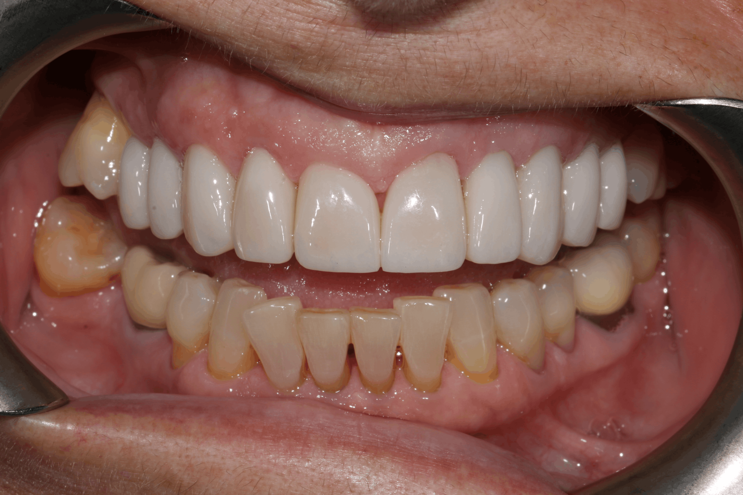 Isabelle before after dental treatment