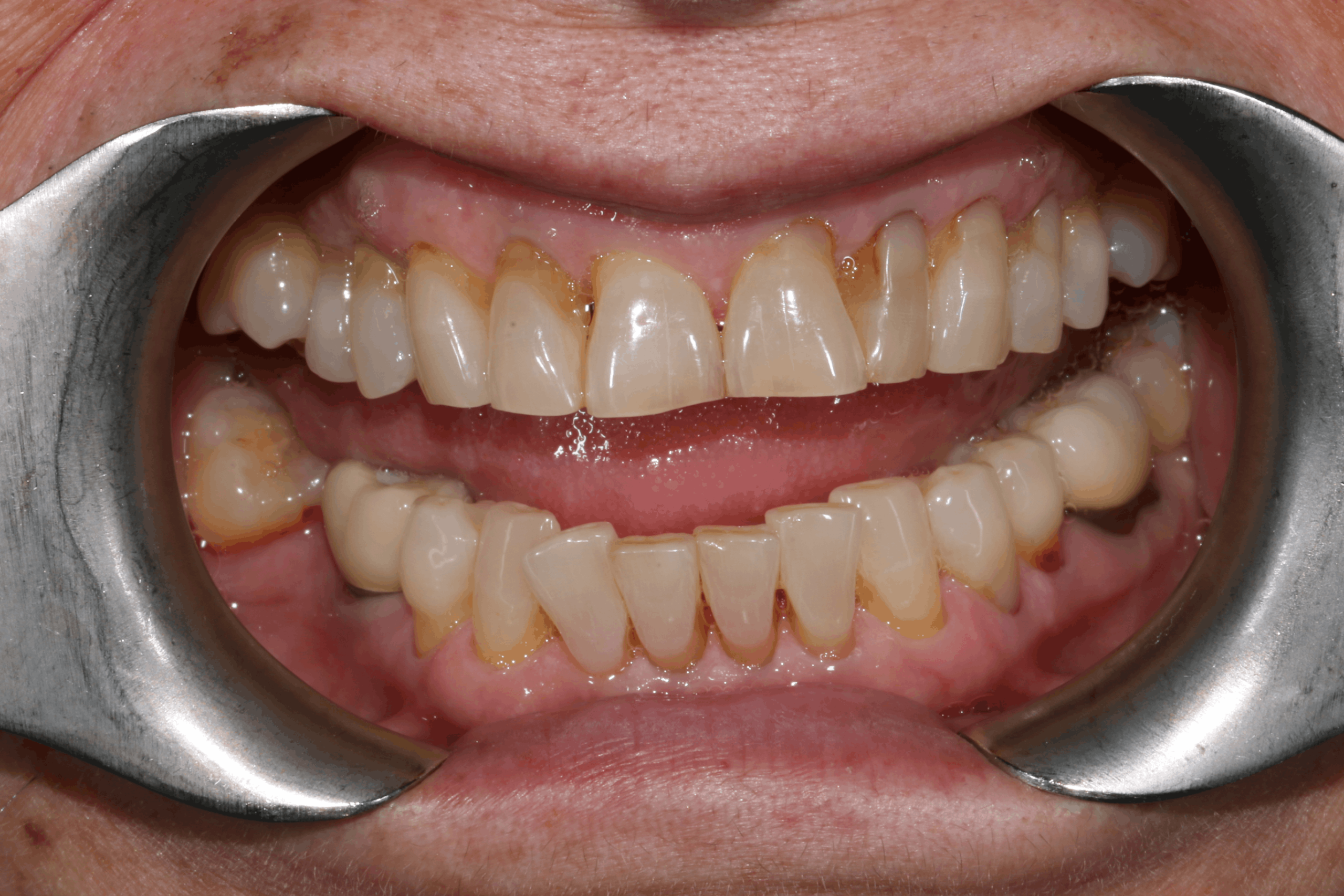 Isabelle before after dental treatment