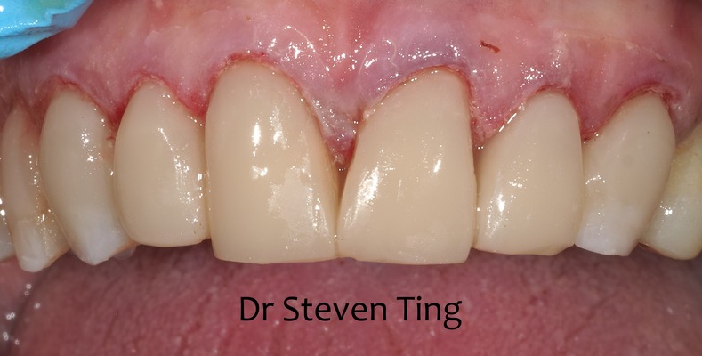 Tony before after dental treatment