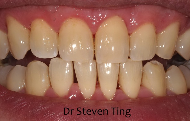Walter before after dental treatment