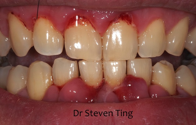 Walter before after dental treatment