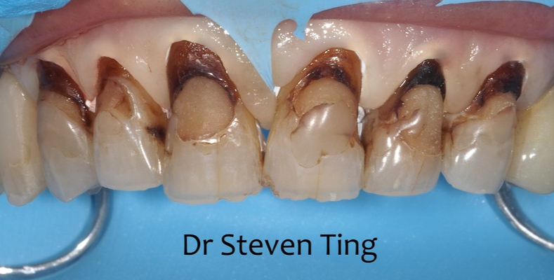 Tony before after dental treatment