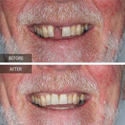 before after dental teeth filling preston