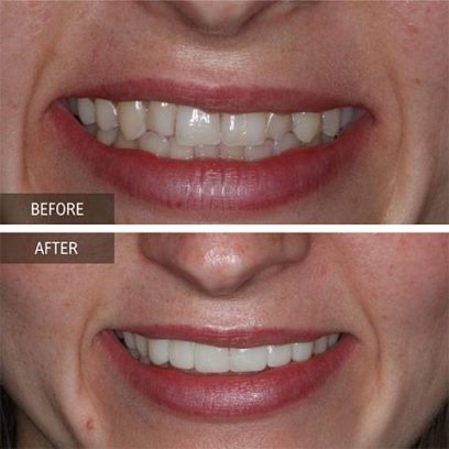 Invisalign treatment in ivanhoe