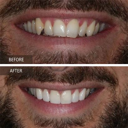 Problem
Discoloured, crowded and worn front teeth

Treatment
Orthodontic treatment with Invisalign, Zoom teeth

Treatment Duration
14 months months