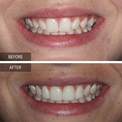 Invisalign clear aligners with elastics