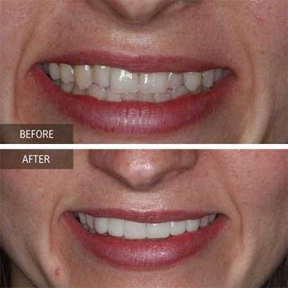 Invisalign treatment