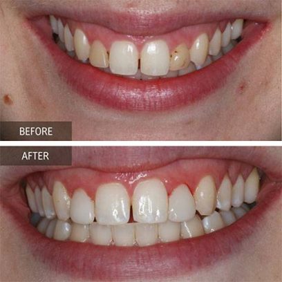 DOI---Veneers-3