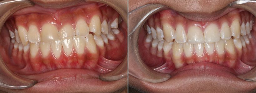 Invisalign orthodontic