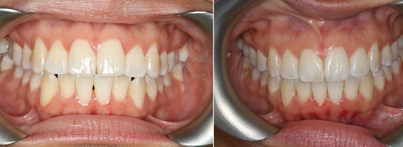 Invisalign clear aligners to straighten front teeth