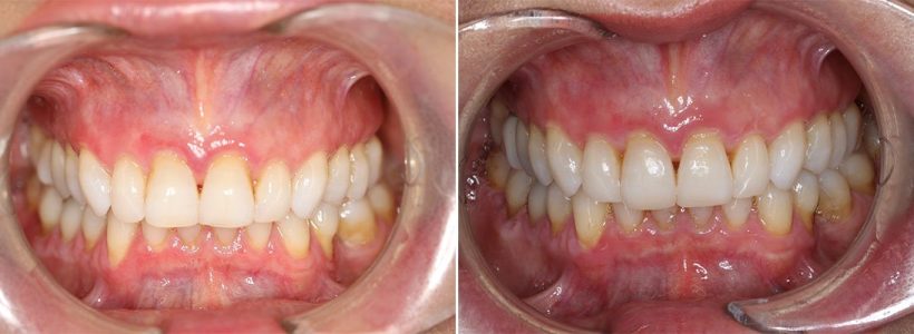 Invisalign orthodontic treatment and composite build up